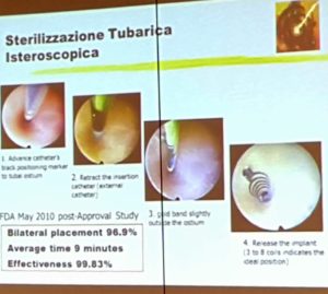 essure cremascoli isteroscopia biomec